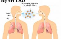 Tăng cường công tác phòng, chống bệnh Lao